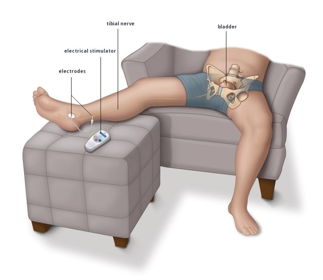 Тибиальная нейромодуляция или электростимуляция тибиального нерва