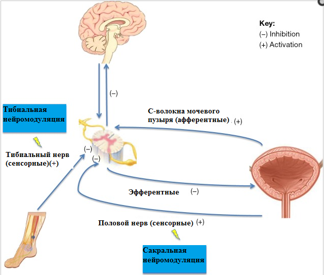 Тибиальная нейромодуляция