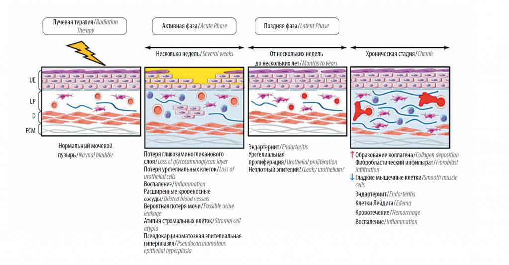 Патогенез лучевого цистита