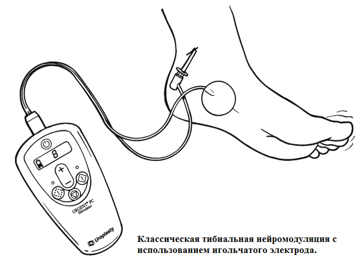 Классическая тибиальная нейромодуляция с использованием игольчатого электрода.