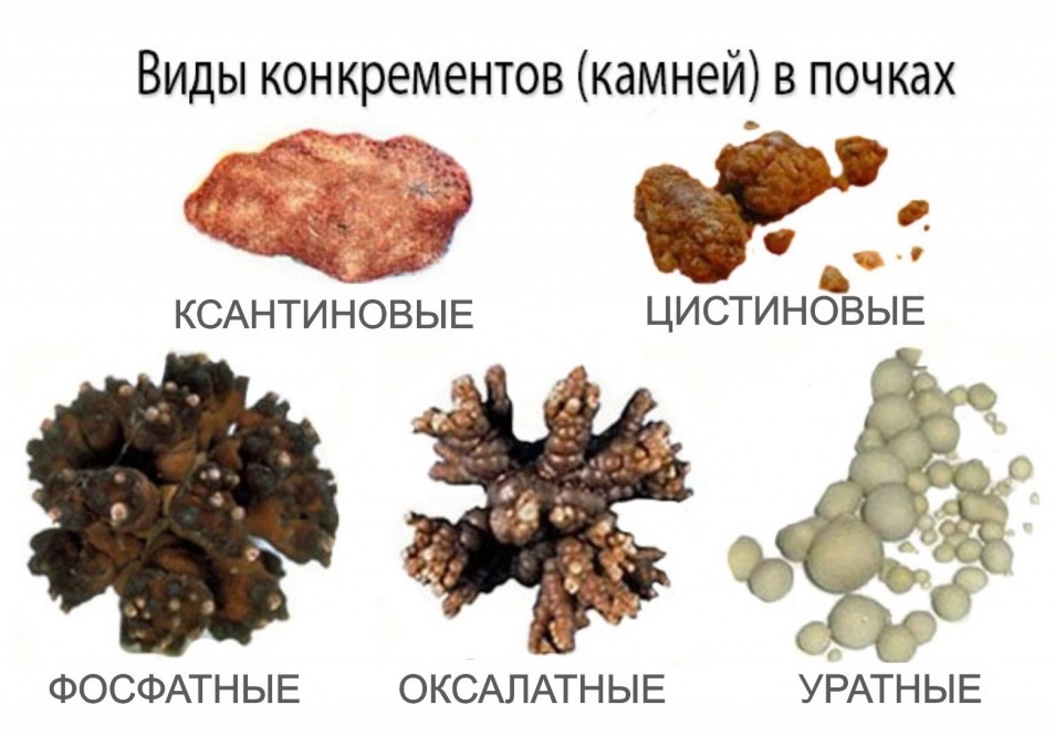 конкременты